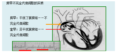 房性期前收縮的心電圖特點(diǎn)