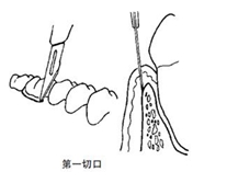 翻瓣術(shù)