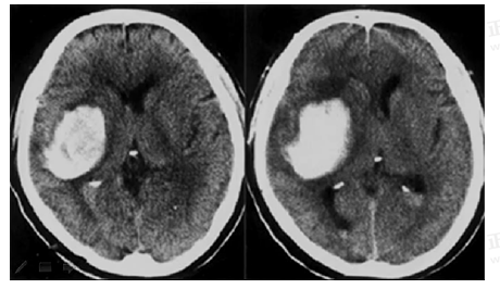 男55歲，左側(cè)肢體偏癱4小時(shí)，有高血壓史，診斷為